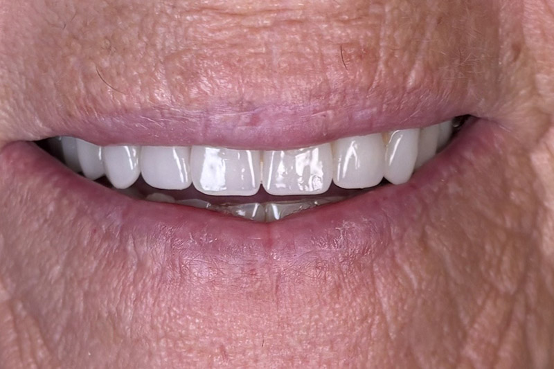 Dental Exam & Cleaning in Newton